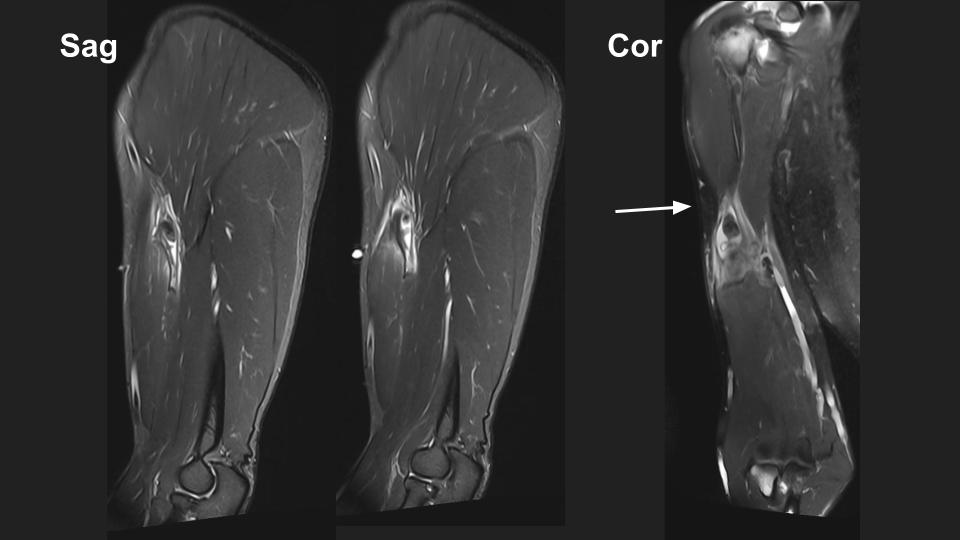 Figure 4 for case tendon of long head of biceps brachii ( RID1944 )